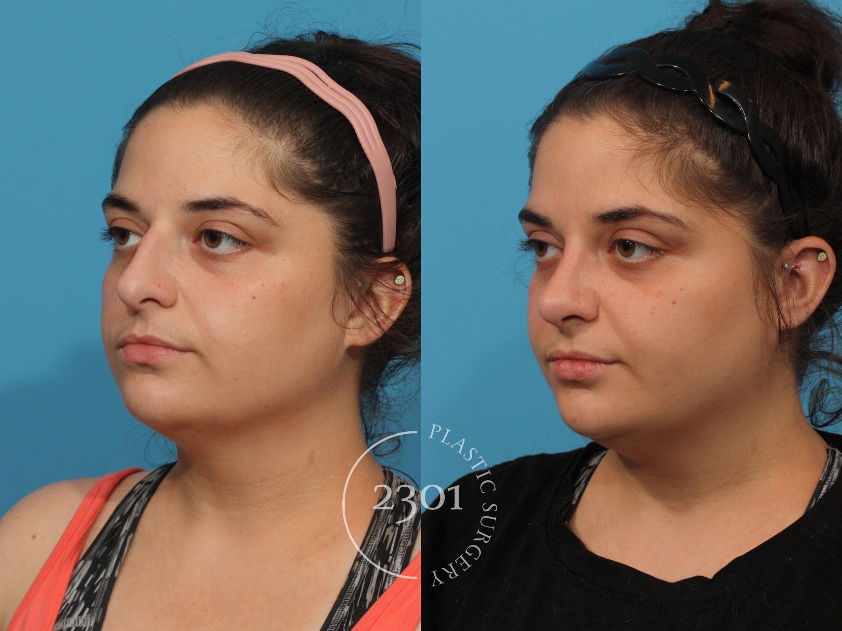 Before & After Rhinoplasty Case 837 Left Oblique View in Fort Worth, Plano, & Frisco, Texas