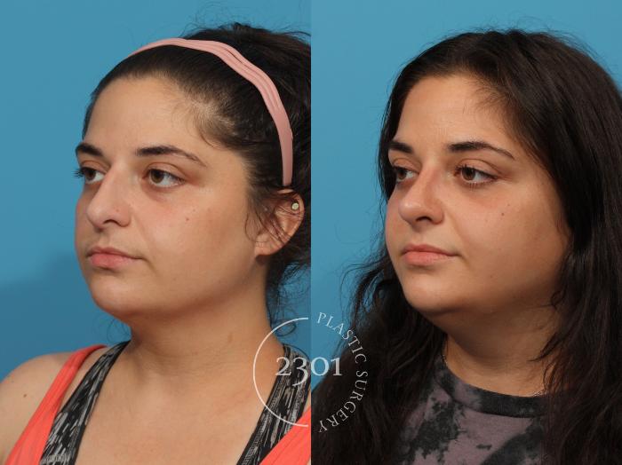 Before & After Rhinoplasty Case 837 Left Oblique View in Fort Worth, Plano, & Frisco, Texas