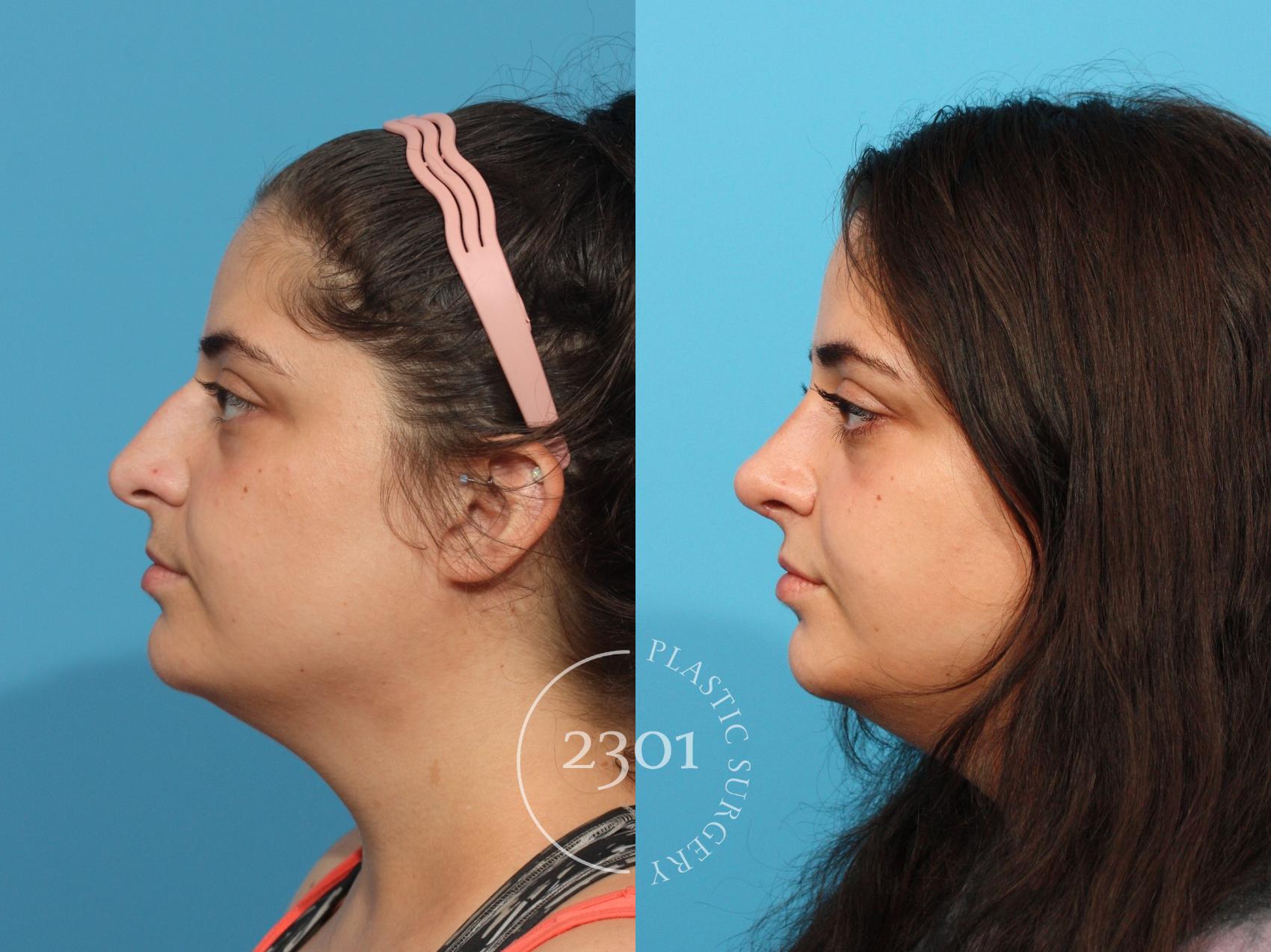 Before & After Rhinoplasty Case 837 Left Side View in Fort Worth, Plano, & Frisco, Texas