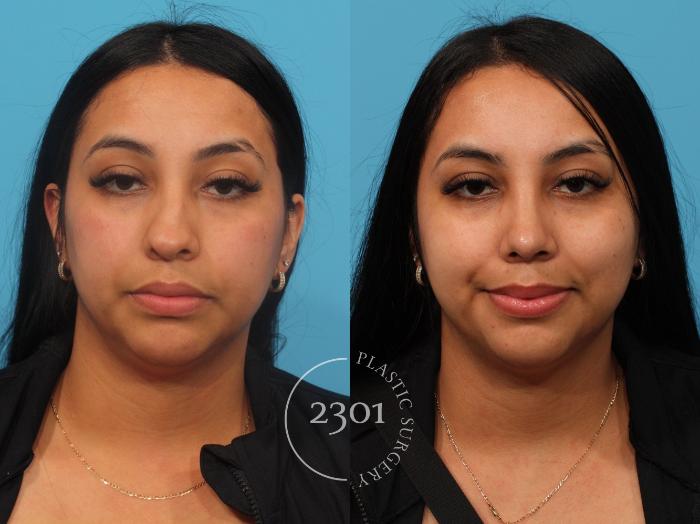 Before & After Rhinoplasty Case 842 Front View in Fort Worth, Plano, & Frisco, Texas