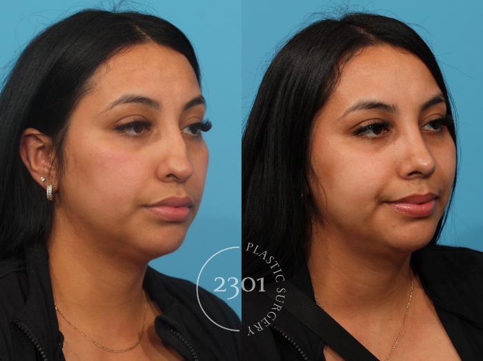 Before & After Rhinoplasty Case 842 Right Oblique View in Fort Worth, Plano, & Frisco, Texas