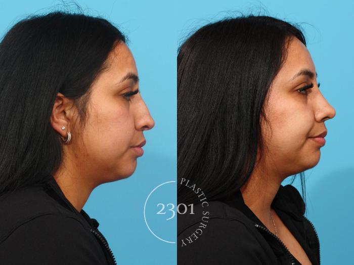 Before & After Rhinoplasty Case 842 Right Side View in Fort Worth, Plano, & Frisco, Texas