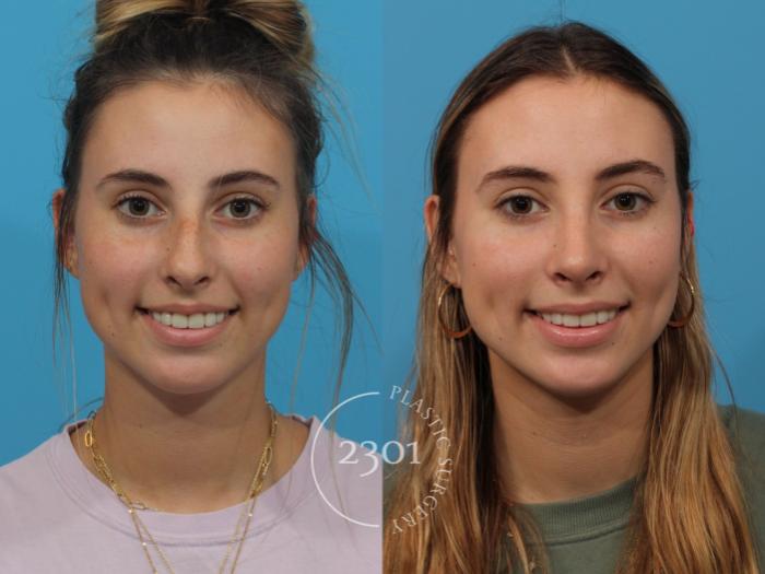 Before & After Rhinoplasty Case 843 Front View in Fort Worth, Plano, & Frisco, Texas