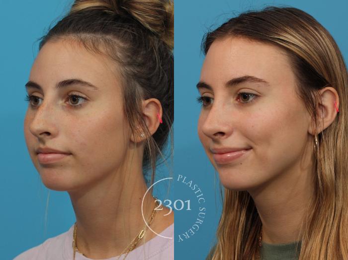 Before & After Rhinoplasty Case 843 Left Oblique View in Fort Worth, Plano, & Frisco, Texas