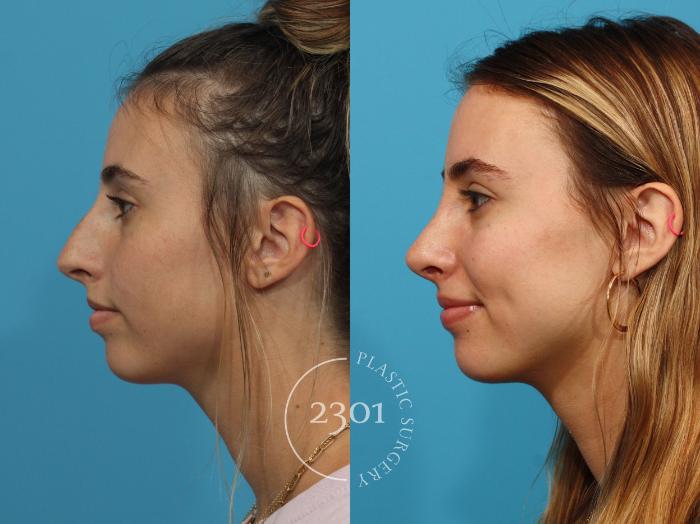 Before & After Rhinoplasty Case 843 Left Side View in Fort Worth, Plano, & Frisco, Texas