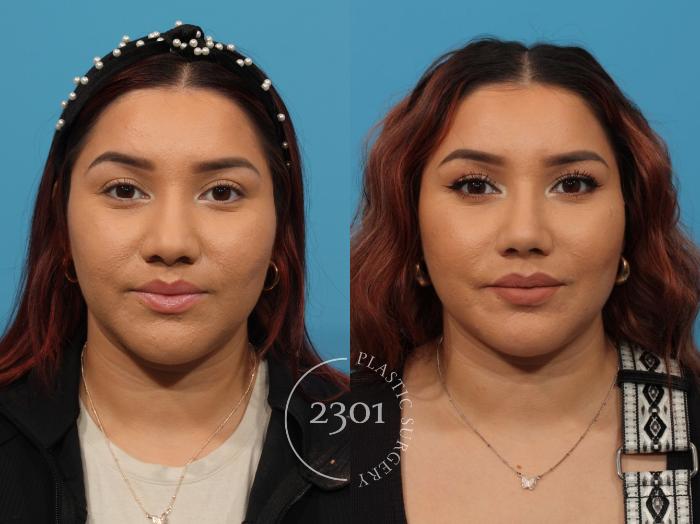 Before & After Rhinoplasty Case 847 Front View in Fort Worth, Plano, & Frisco, Texas