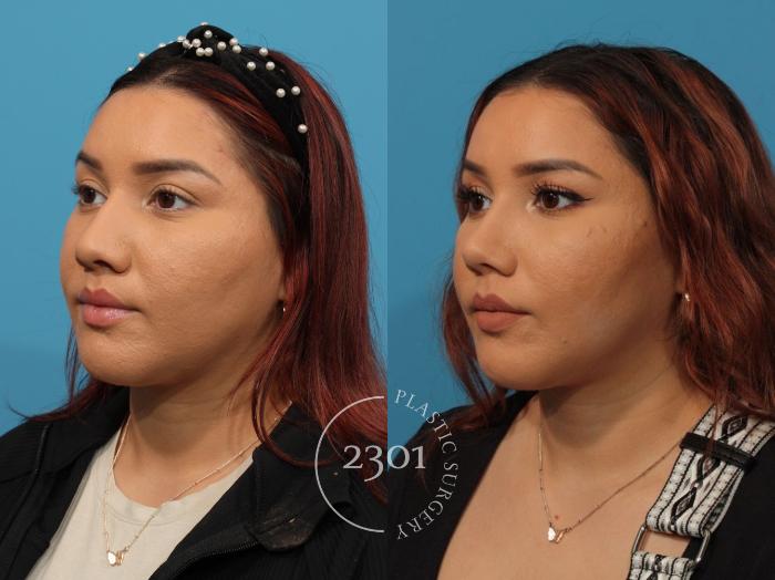 Before & After Rhinoplasty Case 847 Left Oblique View in Fort Worth, Plano, & Frisco, Texas