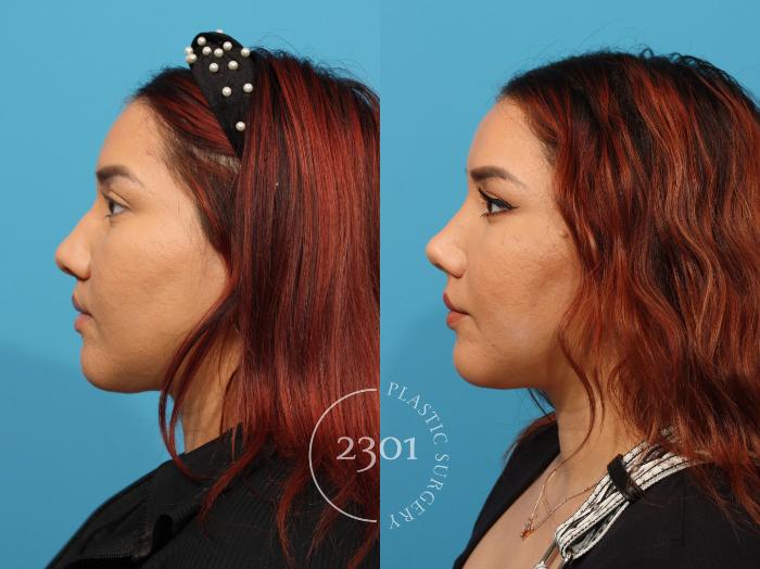 Before & After Rhinoplasty Case 847 Left Side View in Fort Worth, Plano, & Frisco, Texas