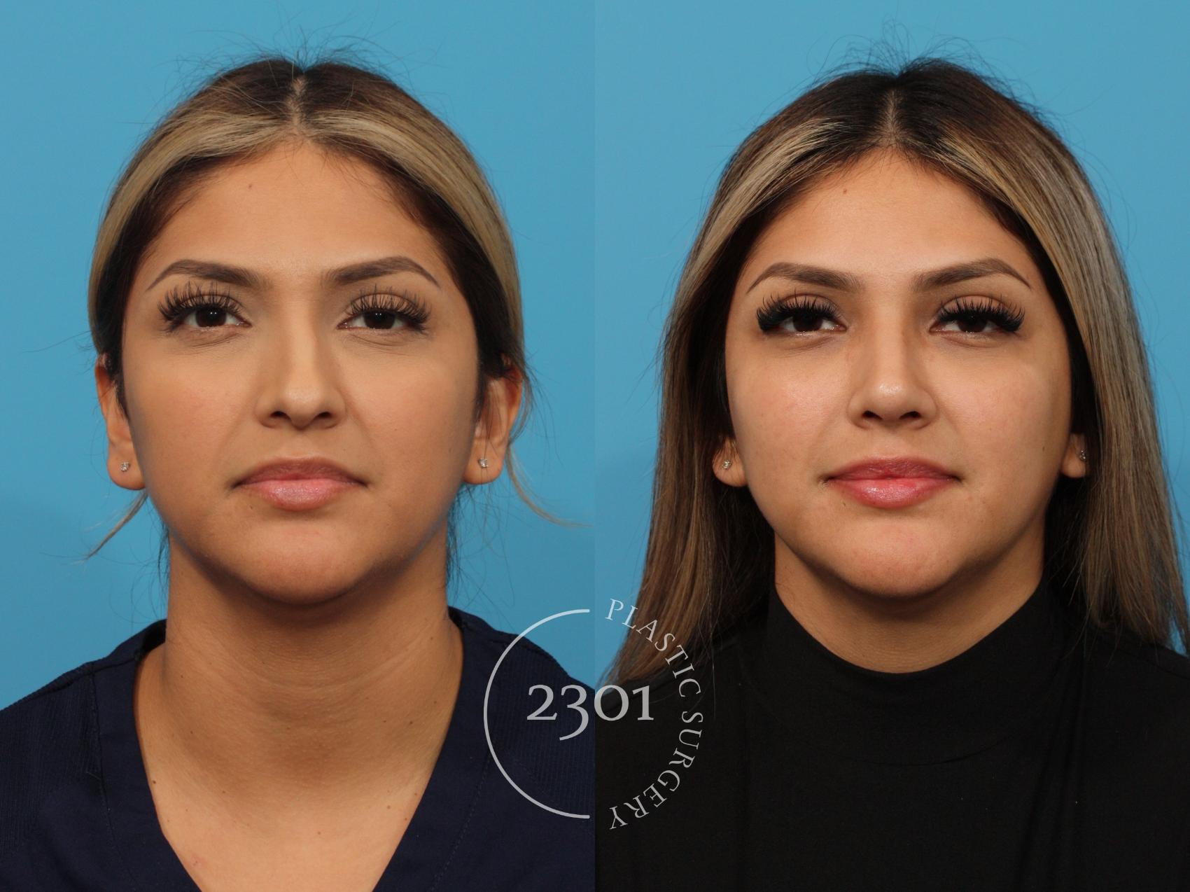 Before & After Rhinoplasty Case 852 Front View in Fort Worth, Plano, & Frisco, Texas