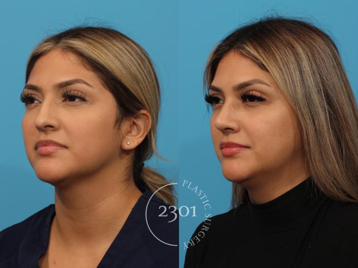 Before & After Rhinoplasty Case 852 Left Oblique View in Fort Worth, Plano, & Frisco, Texas