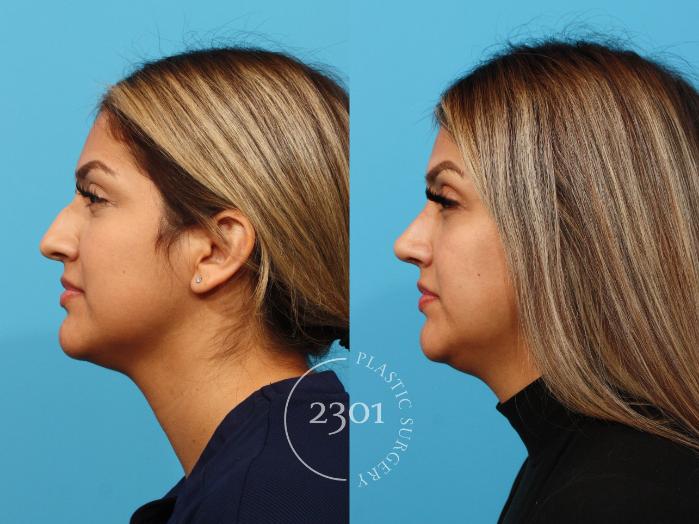 Before & After Rhinoplasty Case 852 Left Side View in Fort Worth, Plano, & Frisco, Texas