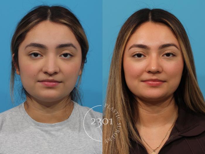 Before & After Rhinoplasty Case 853 Front View in Fort Worth, Plano, & Frisco, Texas