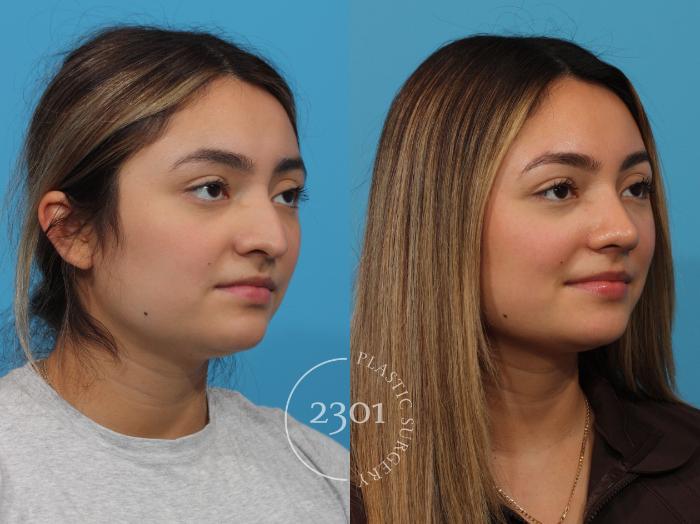 Before & After Rhinoplasty Case 853 Right Oblique View in Fort Worth, Plano, & Frisco, Texas