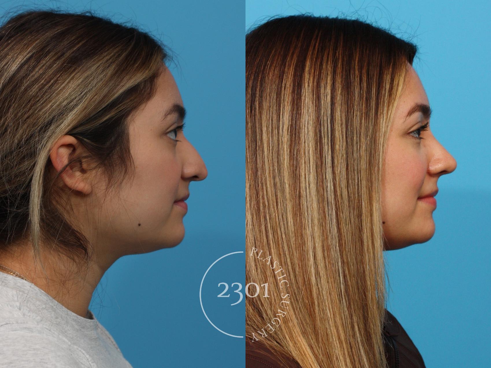 Before & After Rhinoplasty Case 853 Right Side View in Fort Worth, Plano, & Frisco, Texas