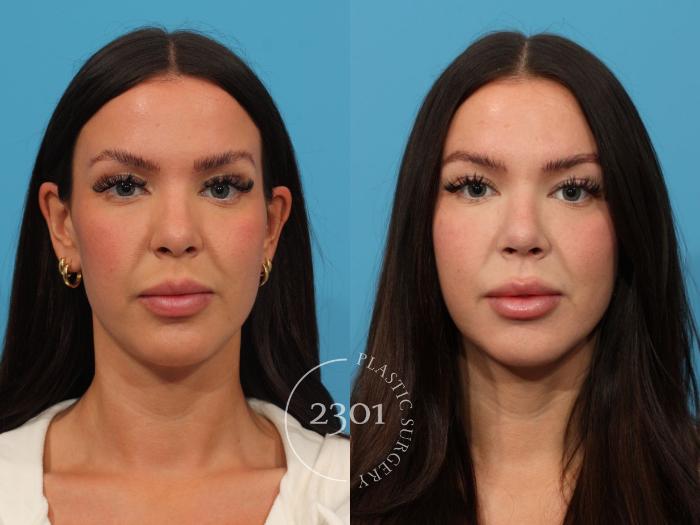 Before & After Rhinoplasty Case 854 Front View in Fort Worth, Plano, & Frisco, Texas