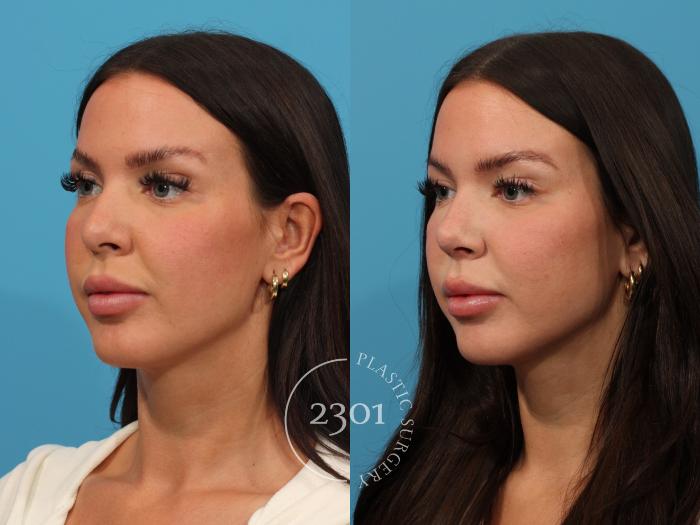 Before & After Rhinoplasty Case 854 Left Oblique View in Fort Worth, Plano, & Frisco, Texas