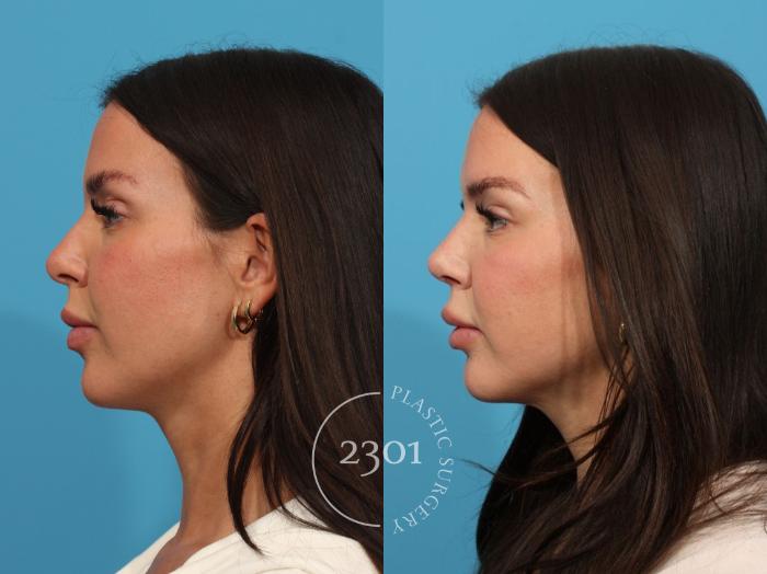 Before & After Rhinoplasty Case 854 Left Side View in Fort Worth, Plano, & Frisco, Texas