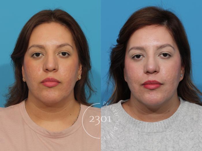 Before & After Rhinoplasty Case 858 Front View in Fort Worth, Plano, & Frisco, Texas