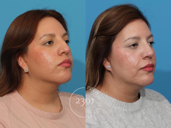 Before & After Rhinoplasty Case 858 Right Oblique View in Fort Worth, Plano, & Frisco, Texas