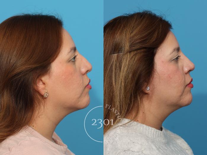 Before & After Rhinoplasty Case 858 Right Side View in Fort Worth, Plano, & Frisco, Texas