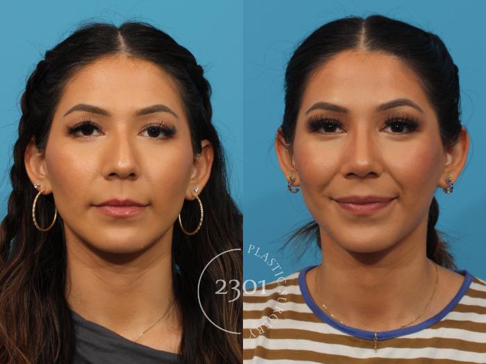 Before & After Rhinoplasty Case 861 Front View in Fort Worth, Plano, & Frisco, Texas