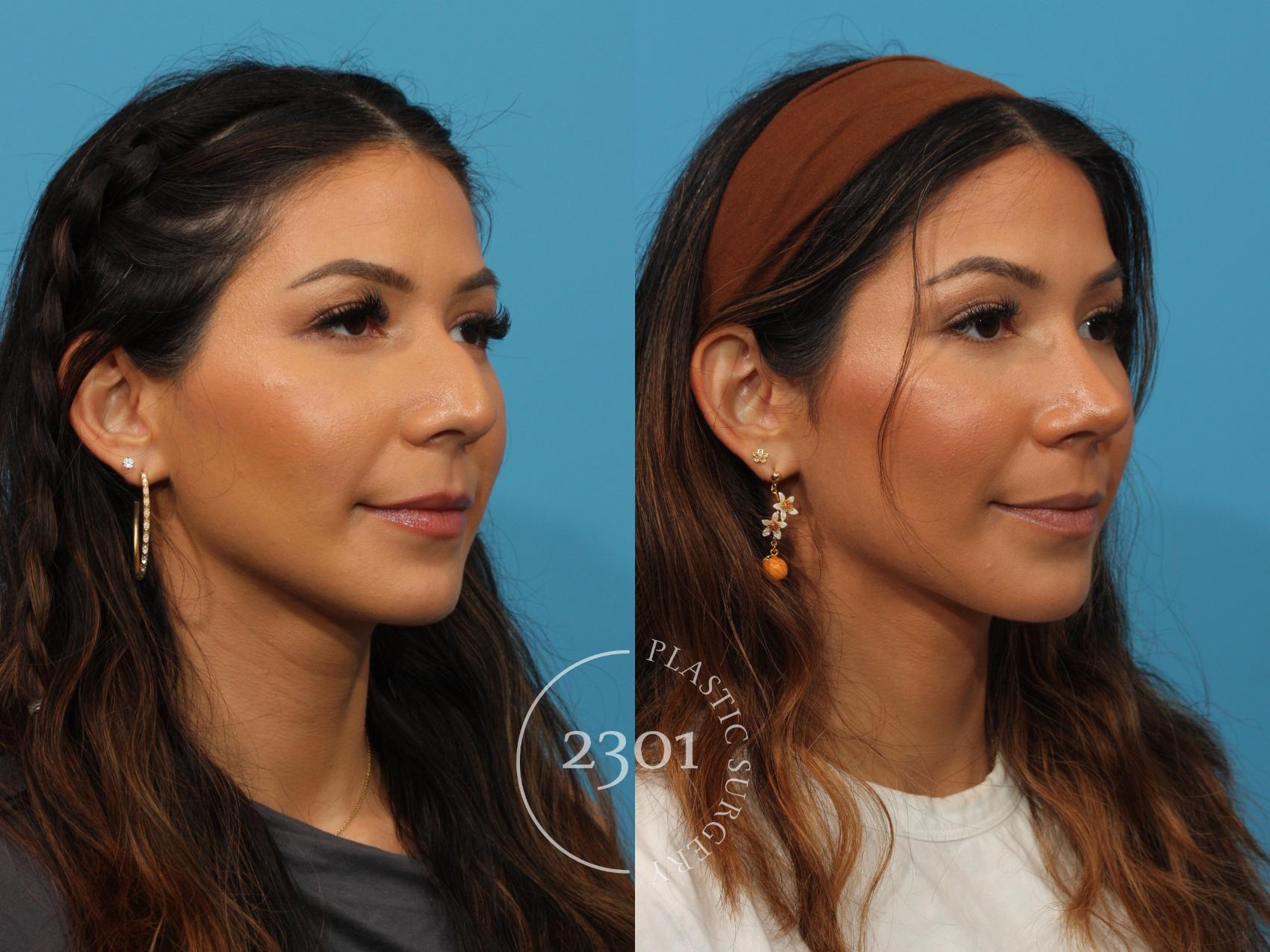Before & After Rhinoplasty Case 861 Left Oblique View in Fort Worth, Plano, & Frisco, Texas