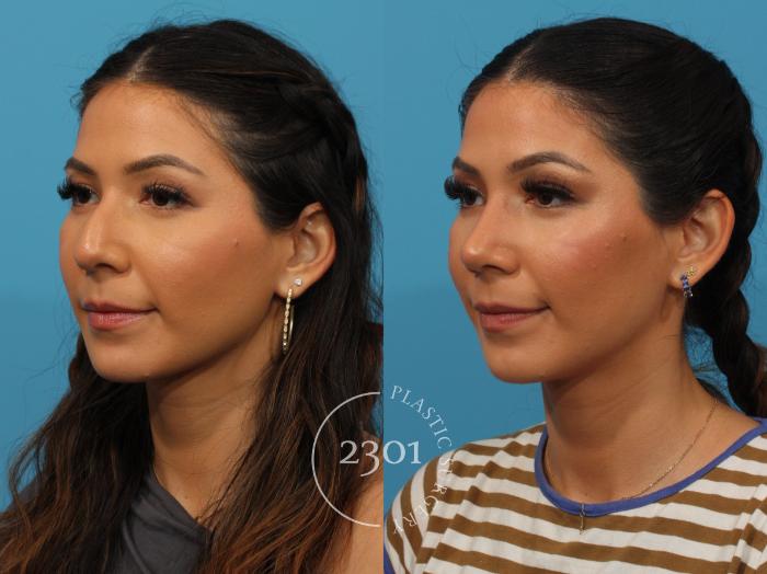 Before & After Rhinoplasty Case 861 Left Oblique View in Fort Worth, Plano, & Frisco, Texas