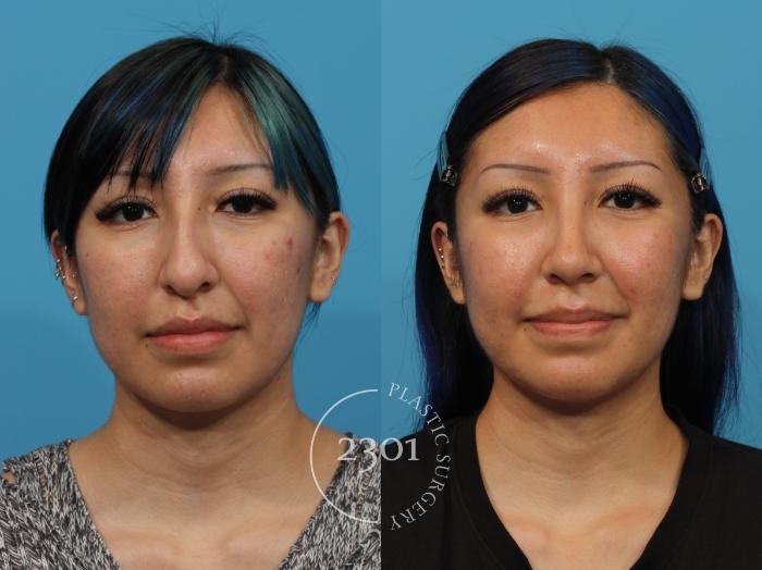 Before & After Rhinoplasty Case 862 Front View in Fort Worth, Plano, & Frisco, Texas