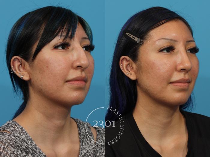 Before & After Rhinoplasty Case 862 Right Oblique View in Fort Worth, Plano, & Frisco, Texas