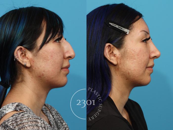 Before & After Rhinoplasty Case 862 Right Side View in Fort Worth, Plano, & Frisco, Texas