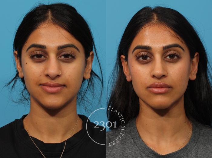 Before & After Rhinoplasty Case 863 Front View in Fort Worth, Plano, & Frisco, Texas