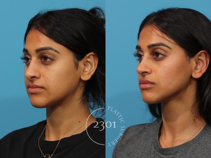 Before & After Rhinoplasty Case 863 Left Oblique View in Fort Worth, Plano, & Frisco, Texas