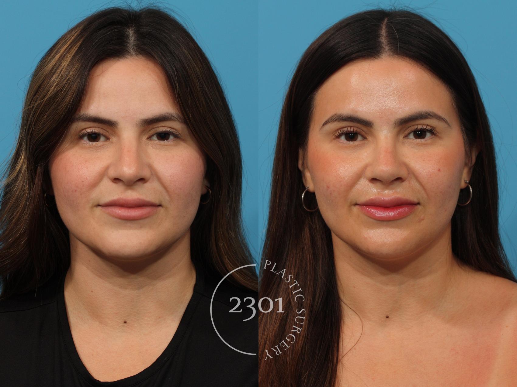 Before & After Rhinoplasty Case 864 Front View in Fort Worth, Plano, & Frisco, Texas