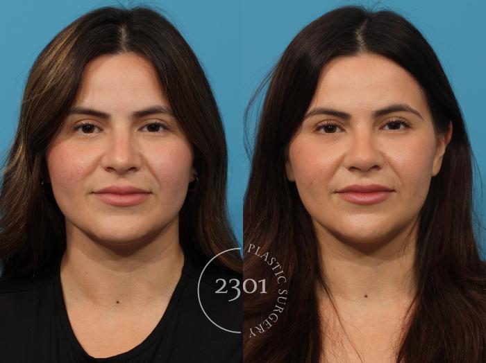 Before & After Rhinoplasty Case 864 Front View in Fort Worth, Plano, & Frisco, Texas