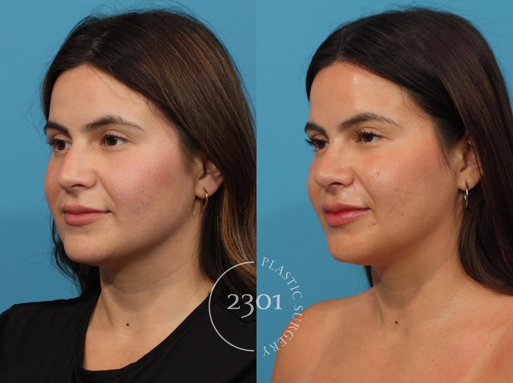 Before & After Rhinoplasty Case 864 Left Oblique View in Fort Worth, Plano, & Frisco, Texas