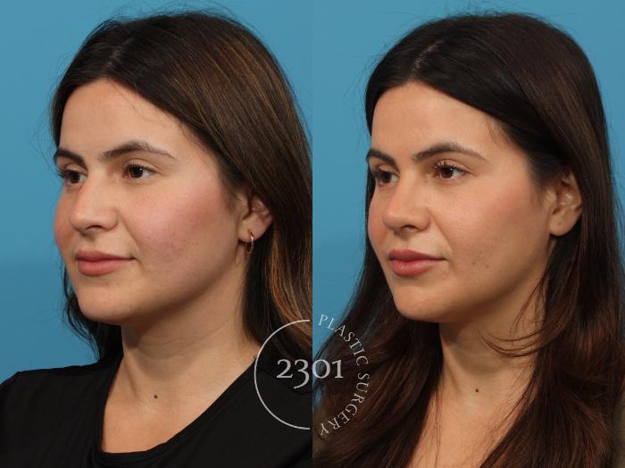 Before & After Rhinoplasty Case 864 Left Oblique View in Fort Worth, Plano, & Frisco, Texas