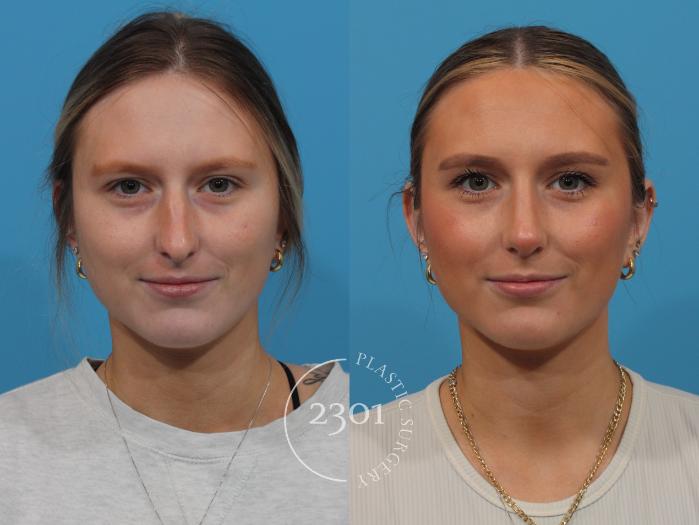 Before & After Rhinoplasty Case 865 Front View in Fort Worth, Plano, & Frisco, Texas