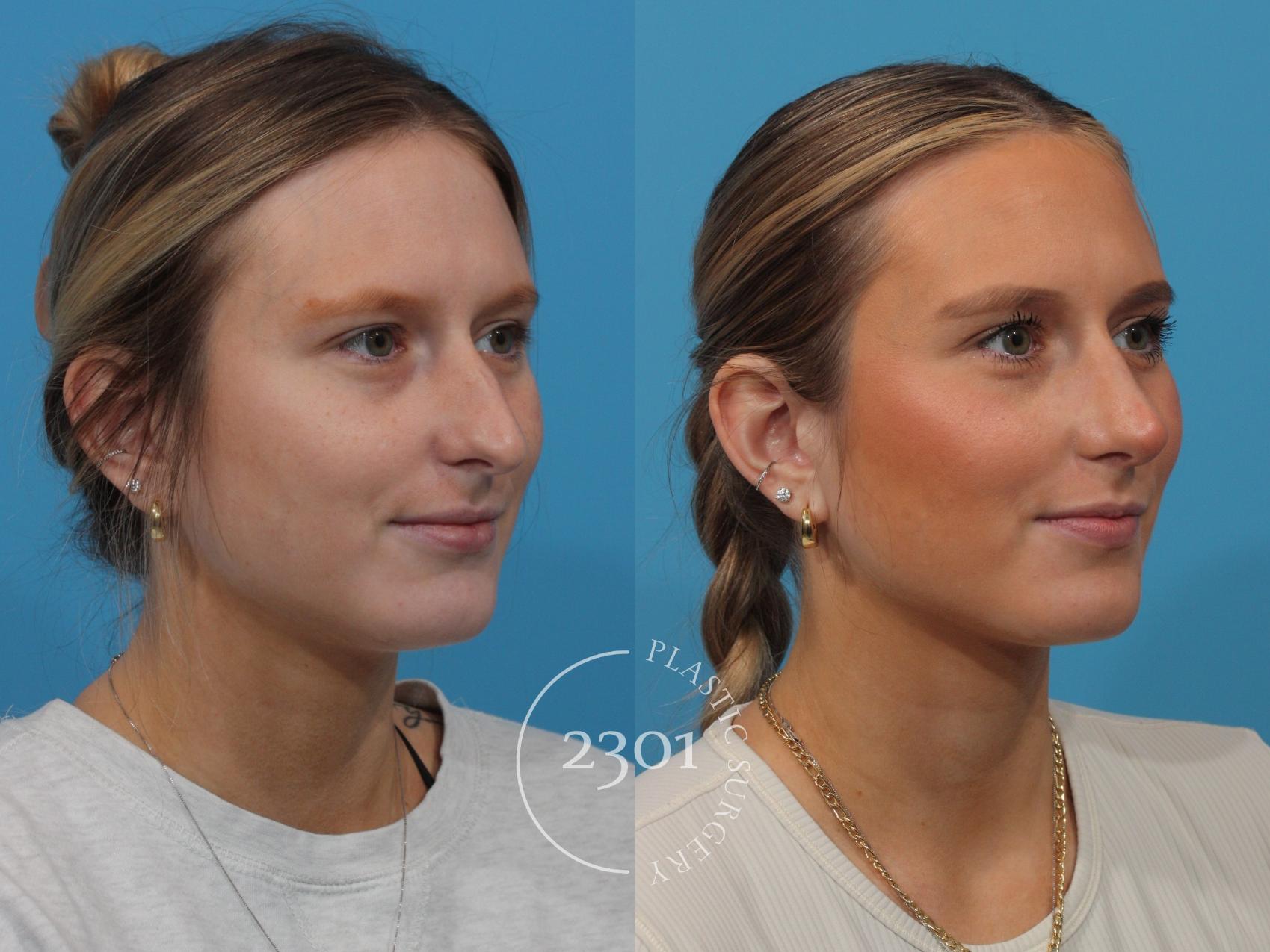 Before & After Rhinoplasty Case 865 Right Oblique View in Fort Worth, Plano, & Frisco, Texas
