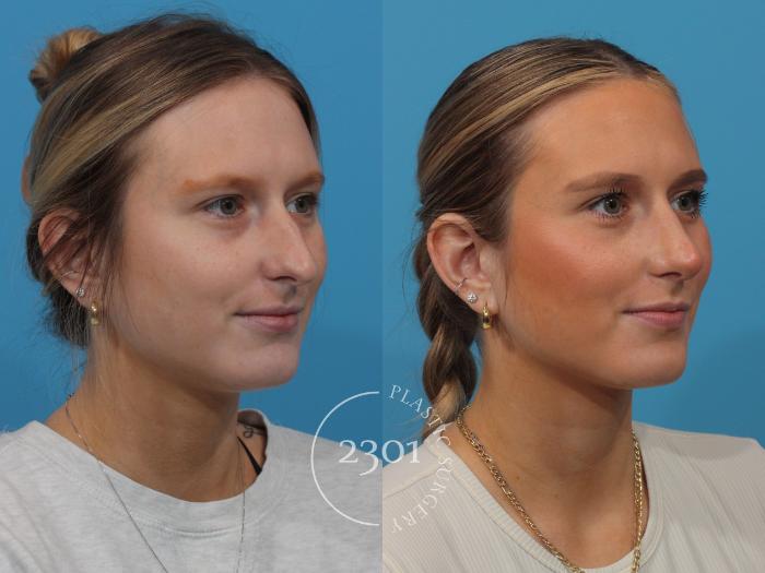 Before & After Rhinoplasty Case 865 Right Oblique View in Fort Worth, Plano, & Frisco, Texas