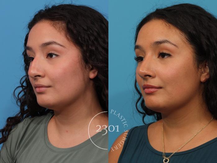 Before & After Rhinoplasty Case 866 Left Oblique View in Fort Worth, Plano, & Frisco, Texas