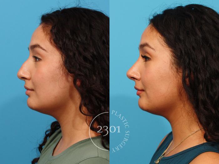 Before & After Rhinoplasty Case 866 Left Side View in Fort Worth, Plano, & Frisco, Texas