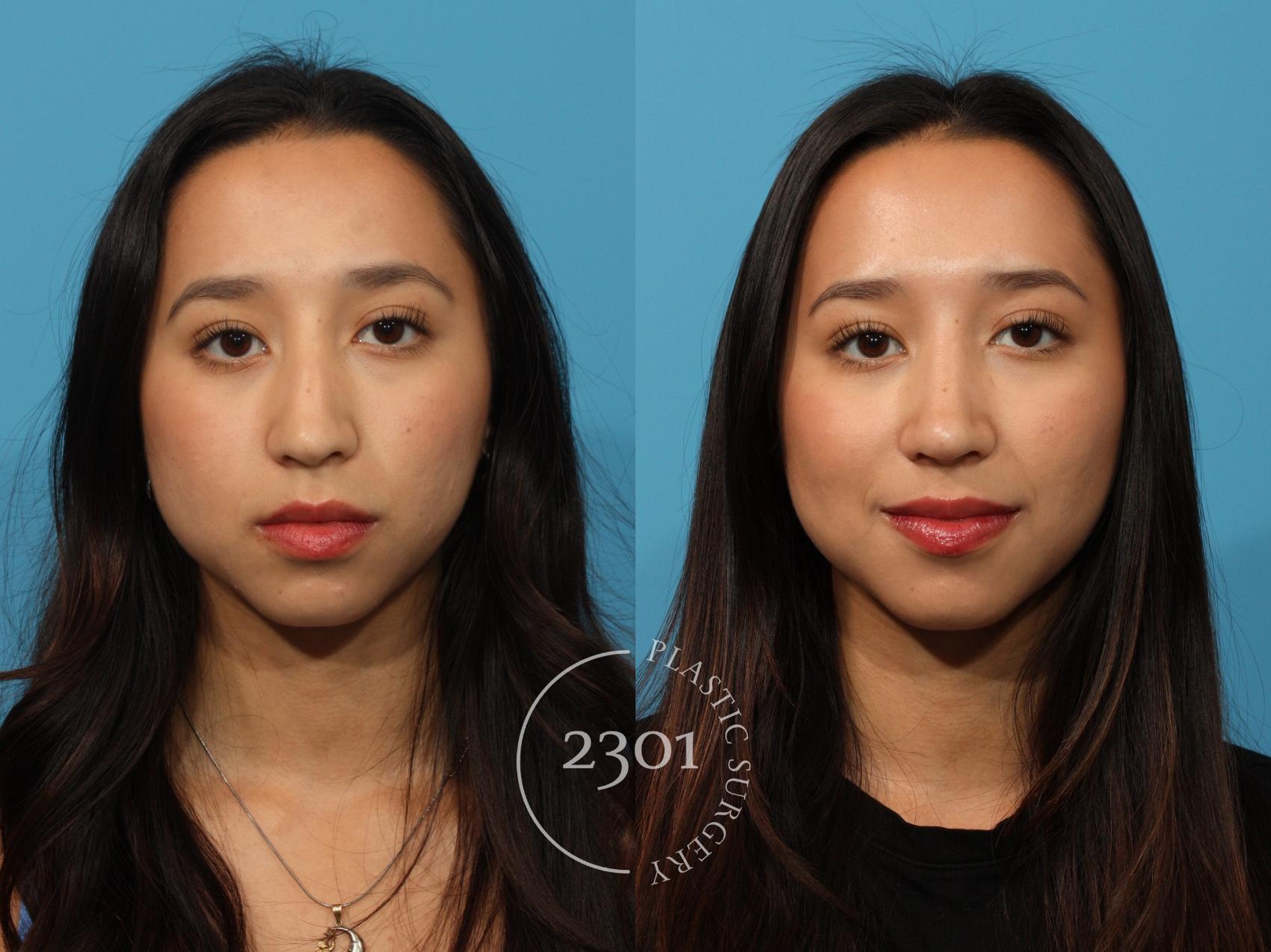 Before & After Rhinoplasty Case 871 Front View in Fort Worth, Plano, & Frisco, Texas