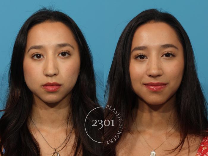 Before & After Rhinoplasty Case 871 Front View in Fort Worth, Plano, & Frisco, Texas