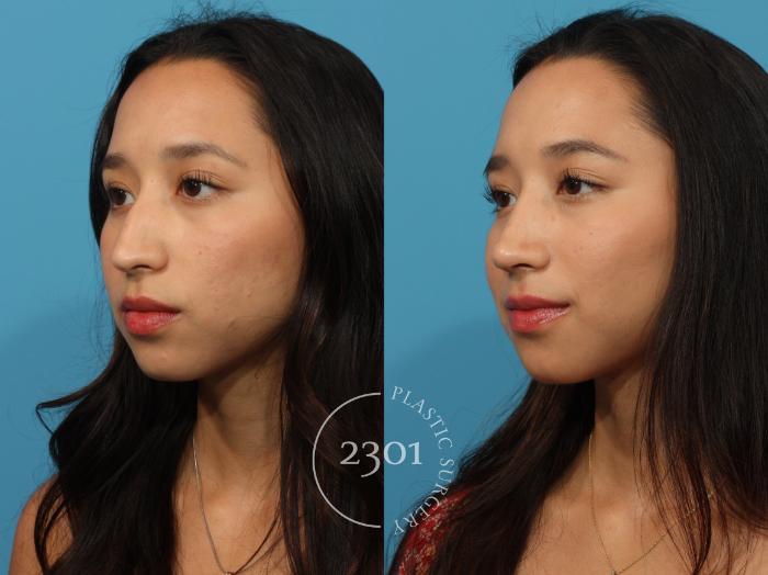 Before & After Rhinoplasty Case 871 Left Oblique View in Fort Worth, Plano, & Frisco, Texas