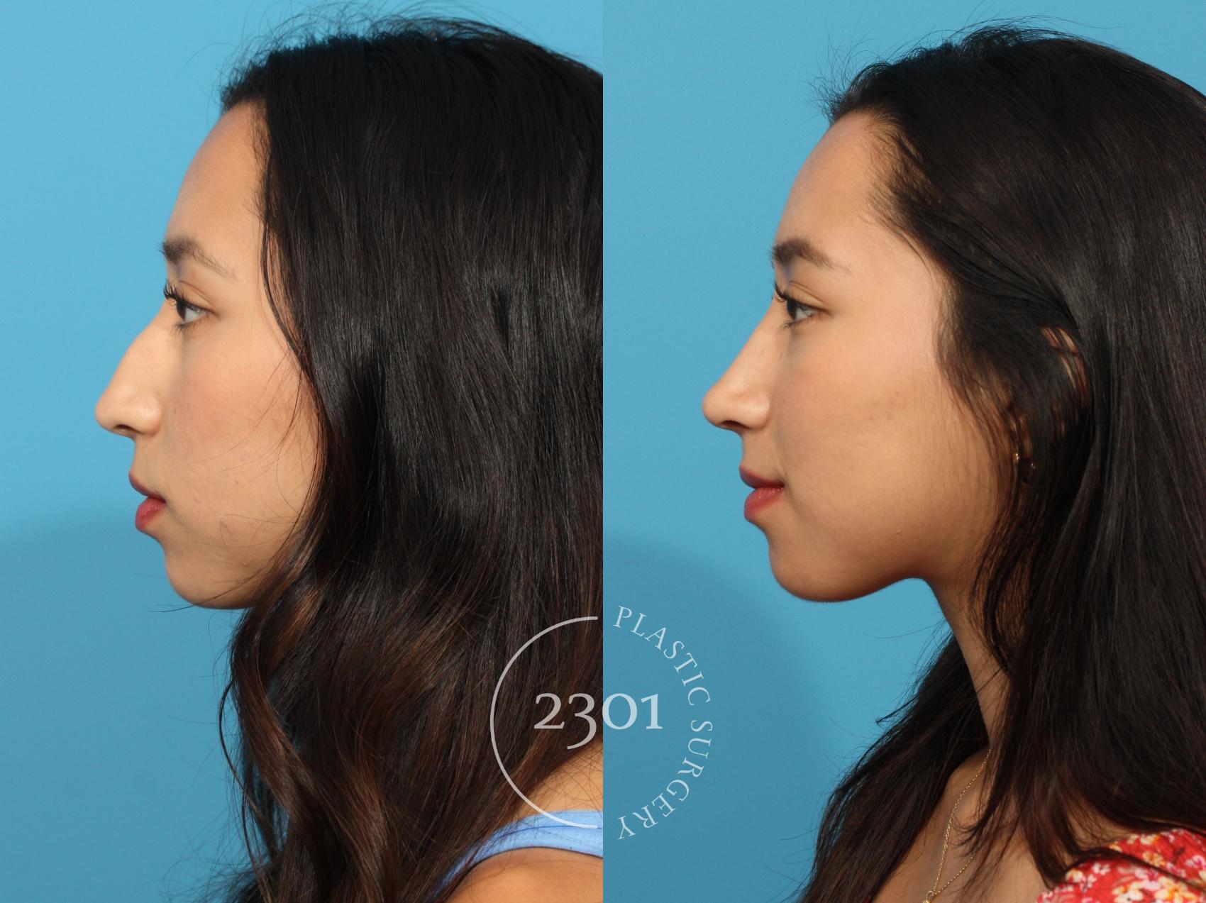 Before & After Rhinoplasty Case 871 Left Side View in Fort Worth, Plano, & Frisco, Texas