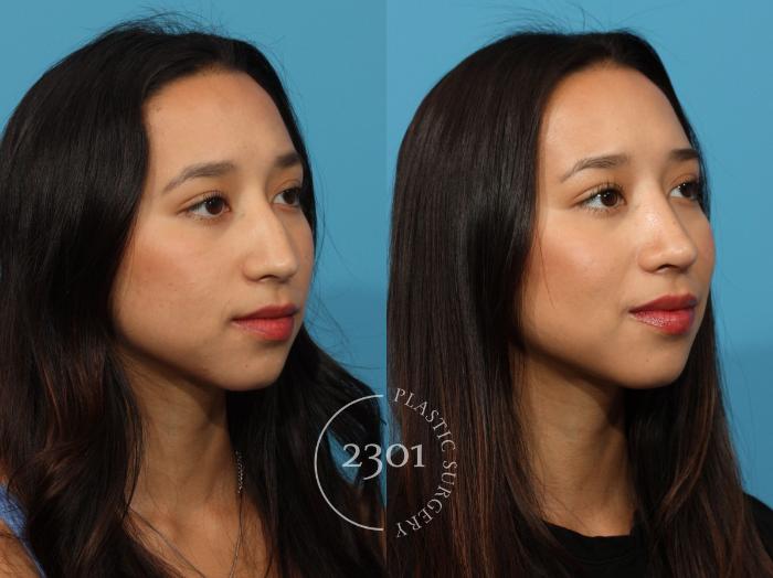 Before & After Rhinoplasty Case 871 Right Oblique View in Fort Worth, Plano, & Frisco, Texas