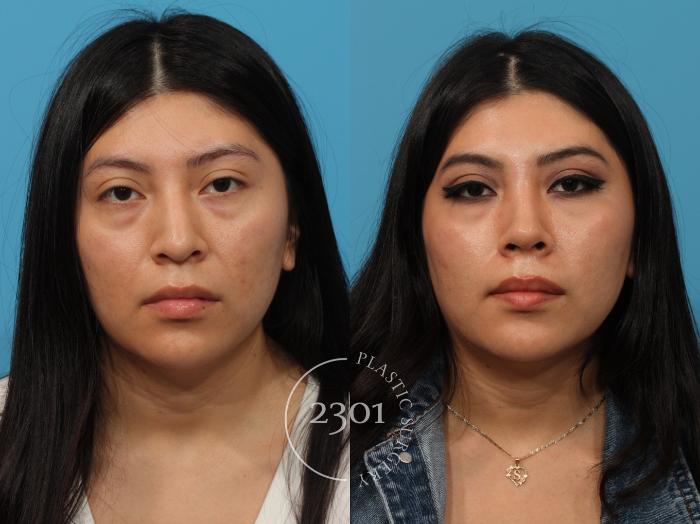 Before & After Rhinoplasty Case 872 Front View in Fort Worth, Plano, & Frisco, Texas
