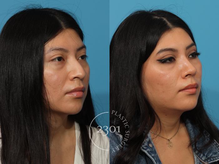 Before & After Rhinoplasty Case 872 Right Oblique View in Fort Worth, Plano, & Frisco, Texas