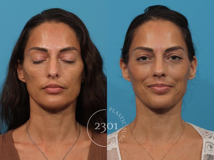 Before & After Rhinoplasty Case 888 Front View in Fort Worth, Plano, & Frisco, Texas