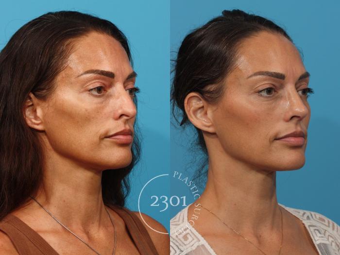 Before & After Rhinoplasty Case 888 Right Oblique View in Fort Worth, Plano, & Frisco, Texas